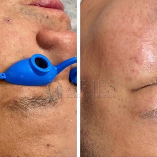 Skin renewal-package