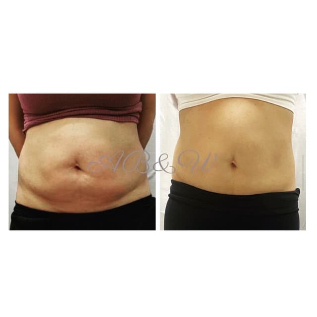 Body Contouring at Aries Beauty & Wellness in Chandler, AZ